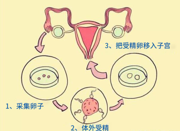 人工授精和试管婴儿的区别