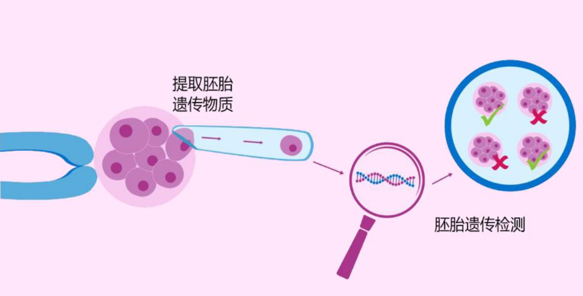 什么是胚胎植入前遗传学检测技术PGT