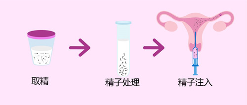 人工授精费用