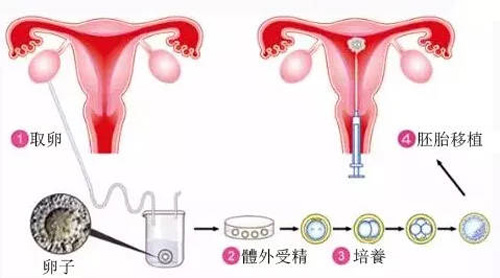 试管婴儿流程