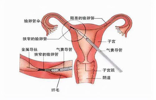 试管婴儿技术