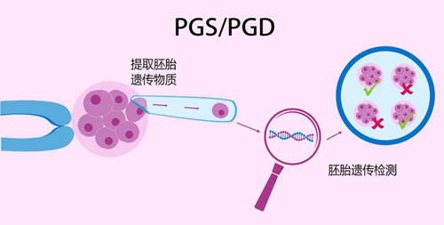第三代试管婴儿PGSPGD技术