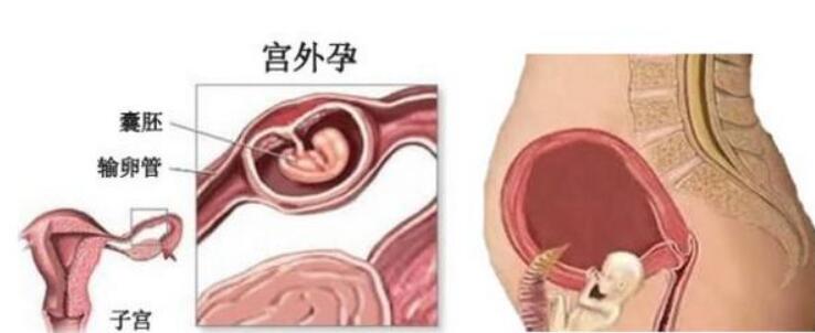 美国试管婴儿