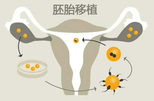 美国试管婴儿移植
