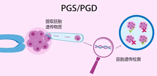 美国试管婴儿PGS/PGD