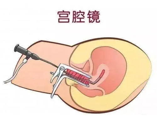 美国试管婴儿宫腔镜检查